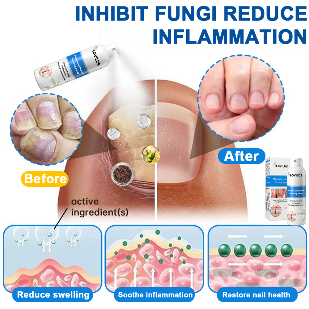 Official Store: LOVILDS™ 👩‍⚕️ Magnesium herbal spray against psoriasis — FDA approved (Relieves psoriasis and eczema, improves bacterial infections in the genital area, treats rosacea and hidradenitis suppurativa, and acne and warts) 🏅