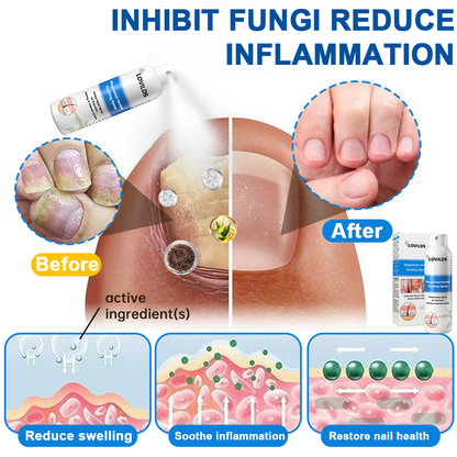 Official Store: LOVILDS™ 👩‍⚕️ Magnesium herbal spray against psoriasis — FDA approved (Relieves psoriasis and eczema, improves bacterial infections in the genital area, treats rosacea and hidradenitis suppurativa, and acne and warts) 🏅