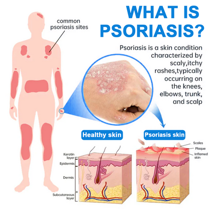 Official Store: LOVILDS™ 👩‍⚕️ Magnesium herbal spray against psoriasis — FDA approved (Relieves psoriasis and eczema, improves bacterial infections in the genital area, treats rosacea and hidradenitis suppurativa, and acne and warts) 🏅